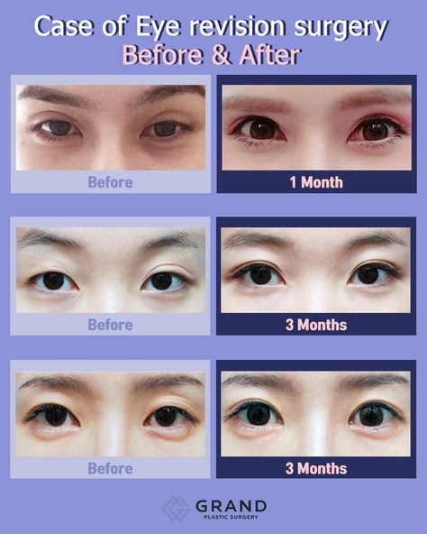 Double Eyelid, Make Up Inspiration, Free Consultation, Plastic Surgery, Makeup Nails, Surgery, Facial, Make Up, For Free