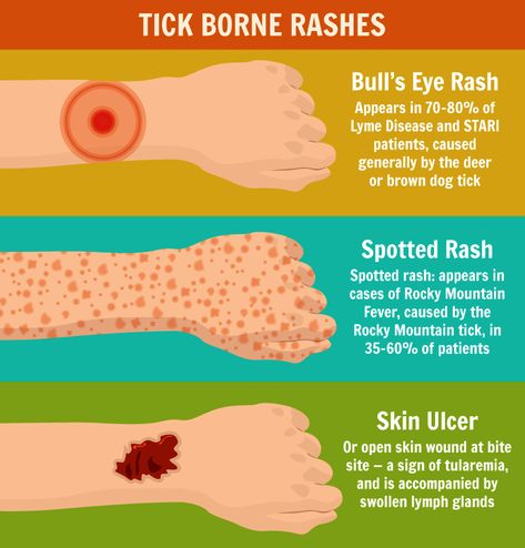 Here’s what you need to know to avoid tick bites, what to do if bitten, and which tick species to watch out for Tick Bite Rash, Tick Bites On Humans, Essential Oils For Fleas, Types Of Ticks, Natural Tick Repellent, Hiking Safety, Lymph Glands, Tick Removal, First Aid Tips