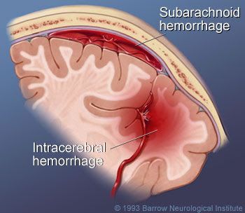 Subarachnoid Space, Subarachnoid Hemorrhage, Types Of Strokes, Brain System, Mental Disease, Brain Tissue, Healthy Cholesterol Levels, Nerve Cell, Cooking With Olive Oil