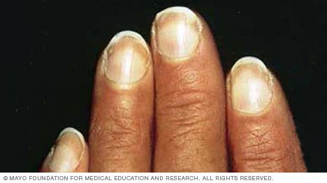 Photo of Terry's nails Clubbing Nails, Nail Disorders, Nail Signs, Nail Hardener, Nail Growth, Heart Problems, Soft Nails, Skin Disorders, Nail Health