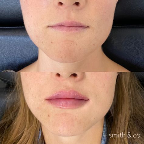 kysse + ashton — Miami Beach Botox Specialist Kysse Lips Filler Before And After, Lip Filler Inspiration 1ml, Keyhole Lips, Lip Fillers Before And After 1ml, Facial Poses, Lip Filler Technique, Botox Lip Flip, 1ml Lip Filler, Restylane Lips