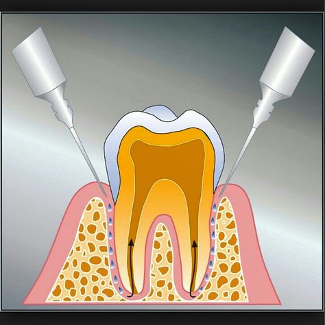 "Intraligamentary anaesthesia" as an alternative to nerve block anaesthesia for extractions; 19,06% of the patients get nerve block anaesthesia. Researches have shown, that in 94.9% Intraligamentary anaesthesia is sufficient for tooth extractions. The study was conducted with 321 teeth (88 teeth in maxilla, 233 teeth in madibula). The patients benefit of fully functional jaw without numbness right after the extraction! This technique also works for prosthetic treatments. Give it a try if you don Tooth Extraction, The Study, Nerve, Quick Saves