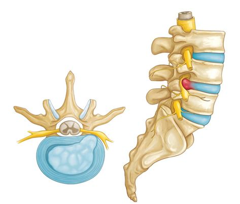 Lumbar Disc, Intervertebral Disc, Disk Herniation, Bulging Disc, Hip Problems, Spinal Nerve, Hip Flexor Stretch, Psoas Muscle, Spine Health