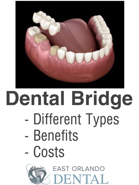 A dental bridge helps bridge the gap created by one or more missing teeth. It consists of two or more crowns for the teeth on both sides of the gap – these anchoring teeth are also known as abutment teeth. Then the false tooth or teeth will be between these anchors. The false teeth are called pontics and can be made from porcelain, alloys, gold, or a combination of these metals. Bridges can be supported by your natural teeth or by implants. Tooth Bridge, Apple Cider Vinegar Health Benefits, Rotten Teeth, Mouth Care, Tooth Crown, Tartar Removal, Best Dental Implants, Tooth Repair, Dental Implants Cost