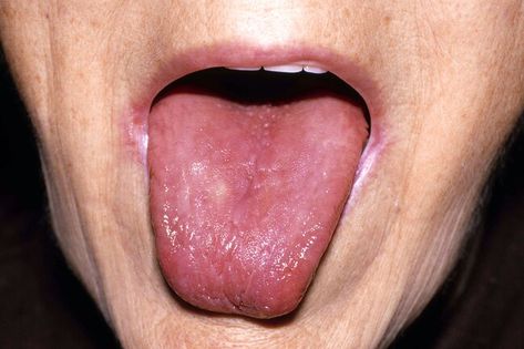 Pictures: Signs You’re Low on Vitamin B12 Burning Tongue, Low Vitamin B12, Tongue Sores, B12 Deficiency, Vitamin B12 Deficiency, Canker Sore, Vitamin Deficiency, Tongue Health, Acidic Foods