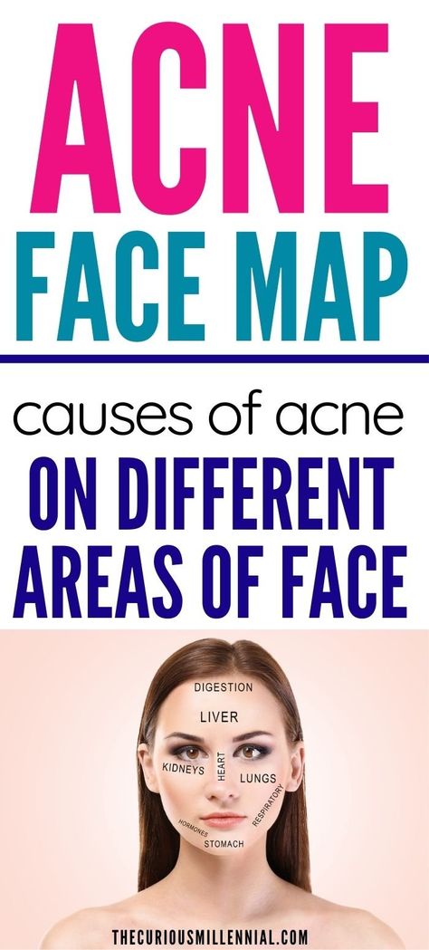 Acne Face Mapping, Pimple Under The Skin, Chin Breakouts, Acne Face Map, What Causes Acne, Home Remedies For Face, Jawline Acne, Cheek Acne, Face Map