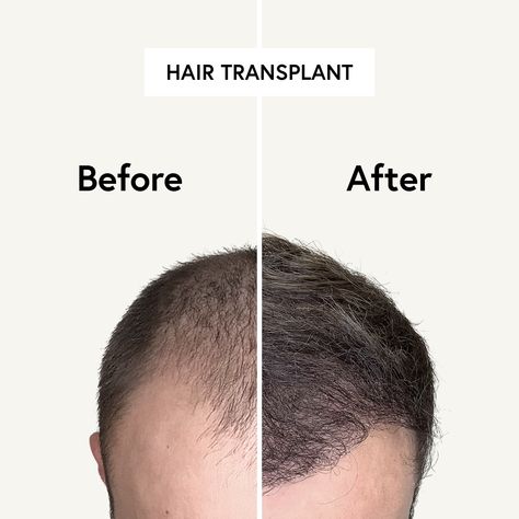 The Most Modern and Gentle Method in Use HAIR & SKIN performs hair transplants with the gentle and advanced FUE method. Learn more about the method and the procedure of a hair transplant with us. ➡️ Book your free appointment now on hairskin.com/?utm_campaign=https%3A%2F%2Fbit.ly%2F3Y9p5dR&utm_medium=organic&utm_source=Pinterest Medical Tourism, Office Set, Hair Transplant, Hair Skin, Hair Products, Medical, Skin, Hair, Quick Saves