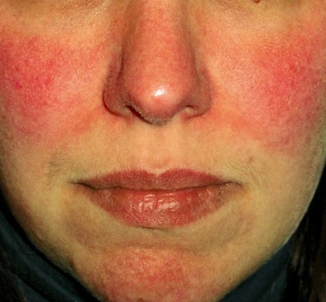 Survey Shows Facial Redness Takes Emotional Toll | Rosacea.org Skin Rash On Face, Rash On Face, Low Stomach Acid, Pimples Remedies, Healing Waters, Skin Redness, Stomach Acid, Sensitive Skin Care, Skin Conditions