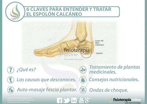 6 claves para entender y tratar el espolón calcáneo | FisioOnline