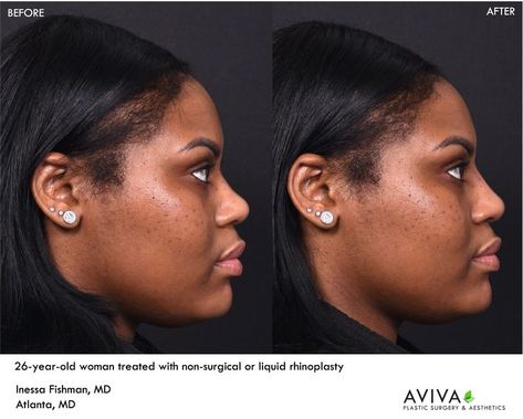 A too-low nasal bridge can be a common aesthetic concern for patients of an African-American or Asian background; this can make the nose look wide or lacking definition. Building up the height of the nose bridge can be done with fillers. The young woman shown wanted more definition to her nose but was hesitant to have surgery. She elected to have a nonsurgical rhinoplasty, otherwise known as a liquidnosejob. The results of the dermal fillers placed to her nose are immediate. Wide Bridge Nose Rhinoplasty, Low Nose Bridge Aesthetic, Wide Nose Women, High Bridge Nose, Flat Nose Bridge, Liquid Rhinoplasty, Low Nose Bridge, Nose Fillers, Asian Background