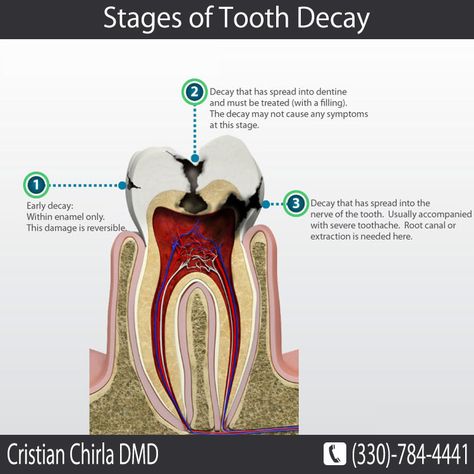 Stages of #Tooth Decay Call us to fix an appointment: (330)-784-4441 Stages Of Decay, Tooth Nerve, Dental Decay, Dental Fun, Dental Facts, Best Teeth Whitening, Patient Education, Dental Surgery, Dental Problems