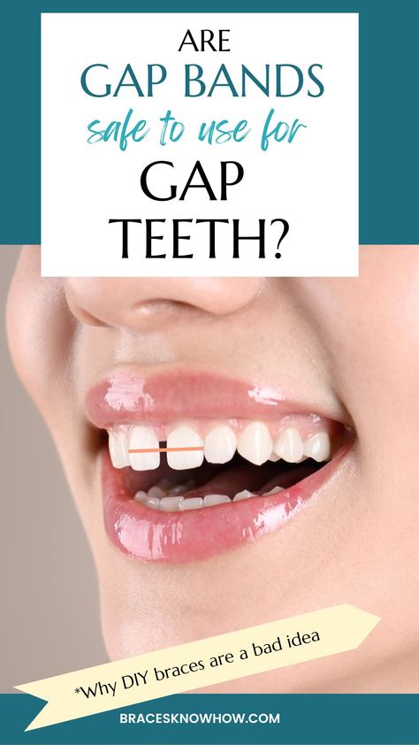 Teeth gap bands are orthodontic bands that are improperly used as DIY braces to close gaps between teeth. While they do work, they pose many risks and the result might not be what you expected. Teeth Gap, Whiten Teeth Naturally, Diy Braces, Tooth Crown, Best Mouthwash, Facial Routine Skincare, Tooth Decay Remedies, Dental Cavities, Gap Teeth