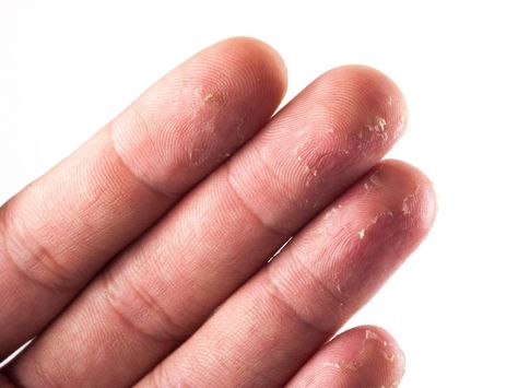 Skin peeling on fingertips: 10 causes Skin Peeling On Hands, Peeling Fingertips, Combination Skin Makeup, Skin Peeling On Face, Dry Skin Body, Dry Skin On Face, Dry Winter Skin, Face Scrub Homemade, Natural Skin Care Routine