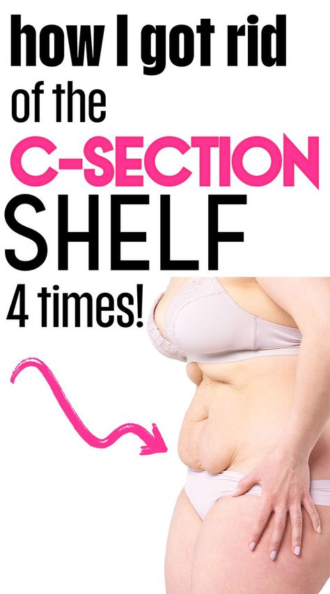 A new mom trying to lose her c-section shelf postpartum tummy with these postpartum workout tips. C Section Pouch, Postpartum Belly Workout, C Section Belly, After C Section Workout, Post C Section, C Section Workout, Pooch Workout, C Section Scars, Mom Belly