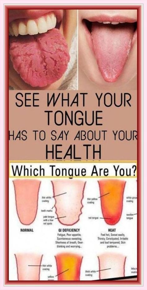 WHAT YOUR TONGUE IS TRYING TO TELL YOU ABOUT YOUR HEALTH Tongue Health, Tongue Cleaner, Feeling Hot, Body Organs, Dull Hair, Shortness Of Breath, Medical Problems, Digestive System, What’s Going On