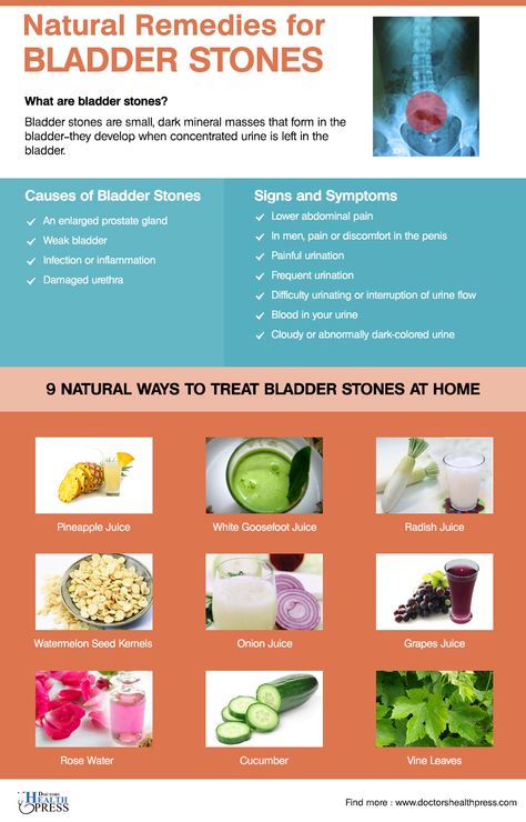 Bladder stones are small, dark mineral masses that form in the bladder—they develop when concentrated urine is left in the bladder. #BladderStones #Health #NaturalRemedies Bladder Leakage Remedies, Weak Bladder, Bladder Stones, Coldsore Remedies Quick, Lower Abdominal Pain, Dry Cough Remedies, Cold And Cough Remedies, Cold Medicine, Losing 40 Pounds