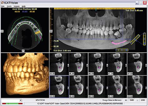 cone beam cbct 500 images for implants Cbct Dental, Study Info, Dental Posters, Dentistry Student, Stronger Teeth, Ct Scan, Family Dental, Root Canal, Patient Experience