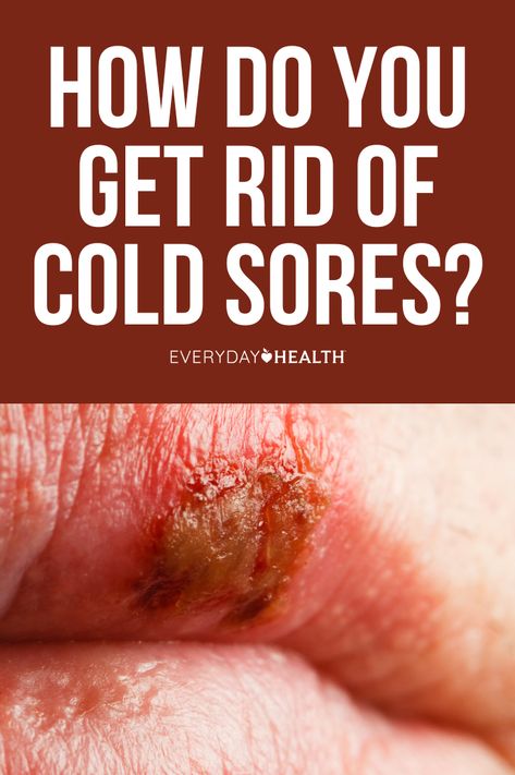 How Do You Get Rid of Cold Sores? What Causes Cold Sores? What Is a Cold Sore? Are Cold Sores Herpes? Are Cold Sores Contagious? What Does a Cold Sore Look Like? How Do You Prevent Cold Sores? What’s the Best Thing to Put on a Cold Sore? What Shouldn’t You Use on One? How Do You Cover Up a Cold Sore? How Common Are Cold Sores? Can You Pop a Cold Sore? Got questions about cold sores? Here’s a look at 10 frequently asked questions to help you recognize, treat, and avoid these blisters. How To Get Rid Of A Cold Sore Overnight, Essential Oils For Cold Sores On Lip, How To Prevent Cold Sores, Cold Sores Remedies Overnight, How To Get Rid Of Cold Sores, Canker Sore Causes, Cold Sore Stages, Blister On Lip, Cold Sore Prevention