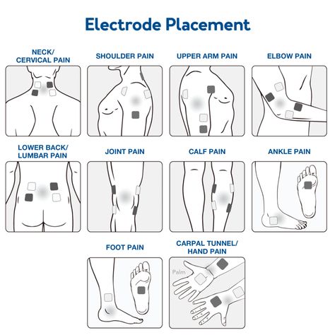 Where To Place Tens Unit Pads, Tens Unit Benefits, Tens Unit Placement Charts, Tens Machine Placement, Tens Electrode Placement, Tens Unit Placement, Physical Therapy Student, Tens And Units, Tens Machine