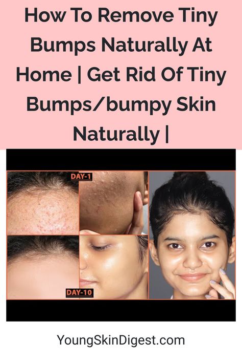 How To Remove Tiny Bumps Naturally At Home | Get Rid Of Tiny Bumps/bumpy Skin Naturally | Bumps On Face How To Get Rid Of, Bumpy Face Remedy, Tiny Pimples All Over Face, Face Bumps Get Rid Of, How To Get Rid Of Face Bumps, How To Remove Bumps On Face, Get Rid Of Bumps On Face, Bumpy Skin Remedies, How To Remove Tiny Bumps On Face