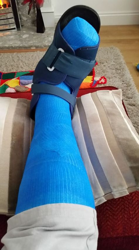 Blue fiberglass total contact cast with cast sandal Broken Leg Cast, Ankle Cast, Walking Cast, Long Leg Cast, Broken Foot, Ankle Surgery, Leg Cast, Body Cast, Beautiful Love Images