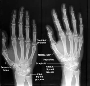 Xray Anatomy, Hand Xray, Wrist Anatomy, Medical Imaging Technology, Radiologic Technology, Sonography Student, Radiology Student, Hand Anatomy, Radiology Imaging