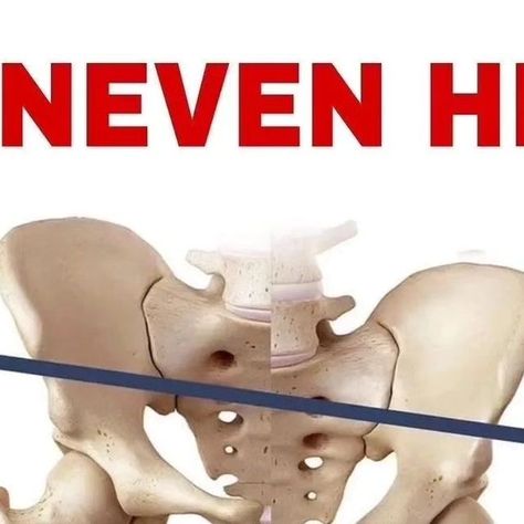 Back Pain Relief Tricks on Instagram: "💥 Uneven hip 💥 Follow @backpainrelieftricks 👈 ⁉️ Do you experience hip shifting during your execution of the squat? Or...when standing, have you noticed that one of your hips is higher than the other? In most cases, uneven hips occurs when you have muscular imbalances that you've developed from lifting or doing any kind of repetitive task. Various asymmetries in the body are expected and perfectly normal. But when your uneven hips (e.g. left hip higher than right or hip shift) starts to cause back pain, hip pain, discomfort, or affect your lifts, then it can start to create problems . . ✅ Muscles commonly involved in these asymmetries include the QL, the gluteus medius, the hip flexors, the adductors, and the glute max . 📢 Then now i will show u h Uneven Hips, Hip Pain Relief, Back Stretches For Pain, Gluteus Medius, Lower Back Pain Relief, Hip Mobility, Sprained Ankle, Joints Pain Relief, Hip Pain