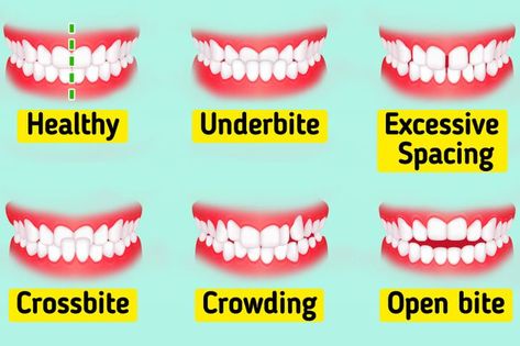 Teeth Types, Different Types Of Teeth, Types Of Teeth, Tongue Thrust, Types Of Humans, Human Teeth, Front Teeth, Whiten Your Teeth, 30 Day Workout Challenge