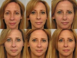 Here's a concrete example of what Sculptra can do for you. Patient had 4 vials Sculptra total over 3 injection sessions, over 6 months. From top left to bottom right. Sculptra Before And After Faces, Sculptra Before And After, Sculptra Injections, Sculptra Filler, Sculptra Aesthetic, Face Plastic Surgery, Body Surgery, Cosmetic Fillers, 컴퓨터 배경화면