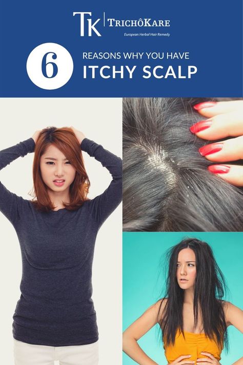 It can be frustrating when you are literally scratching your head over why your scalp itches. Here are some common causes for an itchy scalp and what you should do for relief. Head Itching Remedies, Itching Remedies, How To Remove Dandruff, Scalp Itch, Dandruff Remedy, Herbal Hair, Itchy Scalp, Hair Remedies, Health Info