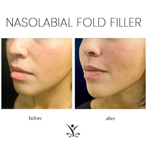 Nasolabial Folds Dermal Fillers Before And After, Nasolabial Folds Filler, Nasal Fold Filler Before And After, Nasiolabel Folds Filler, Nasolabial Folds Dermal Fillers, Facial Balancing Filler, Nasolabial Fold Filler, Eye Lift Surgery, Facial Balancing