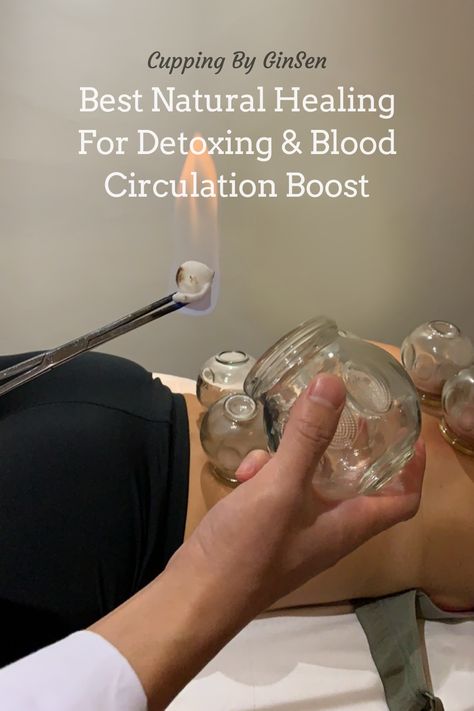 Chinese Cupping, Massage Cupping, Fire Cupping, Chinese Massage, Throbbing Headache, Channeling Energy, Kensington And Chelsea, Cupping Therapy, Improve Blood Circulation