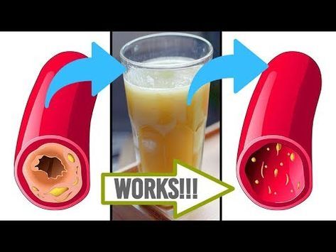 Clear Arteries Naturally, How To Clean Your Arteries Fast, Artery Cleanse Juice, Blocked Arteries Remedies, Vascular Cleansing, Unclog Arteries Natural, Clear Arteries, Artery Cleanse, Clean Arteries