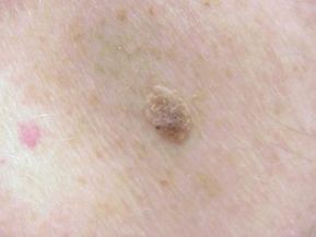 Seborrheic Keratosis, Remove Skin Tags Naturally, Skin Growths, Brown Spots Removal, Home Health Remedies, Skin Disorders, Natural Health Remedies, Brown Spots, Natural Herbs