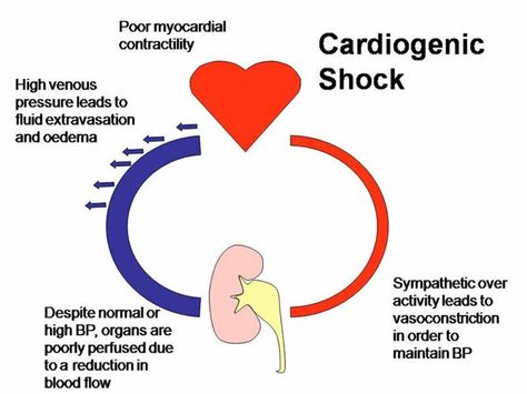 cardiogenic shock | cardiogenic shock Health Insurance Quotes, Cardiogenic Shock, Paramedic School, Cardiac Disease, Nursing Mnemonics, Cardiac Nursing, Critical Care Nursing, Respiratory Therapy, Emergency Nursing