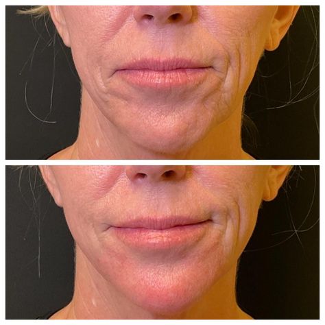 𝐂𝐡𝐢𝐧 + 𝐏𝐫𝐞𝐣𝐨𝐰𝐥 𝐅𝐢𝐥𝐥𝐞𝐫 💉 Chin filler makes a big difference in restoring volume, lengthening as well as projecting the chin for overall facial balancing. 𝐴𝑑𝑑𝑖𝑛𝑔 𝑓𝑖𝑙𝑙𝑒𝑟 𝑡𝑜 𝑡ℎ𝑖𝑠 𝑎𝑟𝑒𝑎 𝑤𝑖𝑙𝑙 𝑔𝑖𝑣𝑒 𝑚𝑜𝑟𝑒: - Definition & structure to the lower face - Sharpen the jawline - Contour the face Kelci Hunter, NP | @the.arizona.injector 📍 @vidabellamedspa | Glendale, AZ 💻 www.vidabellamedspa.com 📱(623) 277-7761 👩‍💻 Book online using link in bio ⇨ @the.arizona.injector . . . #azinjector #chinfiller #prejowl... Jawline Contour, Facial Balancing, Chin Filler, Glendale Az, Books Online, The Face, Arizona, Facial, Overalls