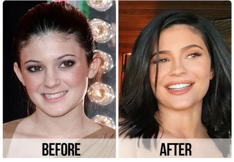 Celebrity Veneers, Smile With Teeth, Cosmetic Dentistry Procedures, Teeth Covers, Composite Veneers, Hollywood Smile, Tooth Removal, Posh Spice, Lip Filler