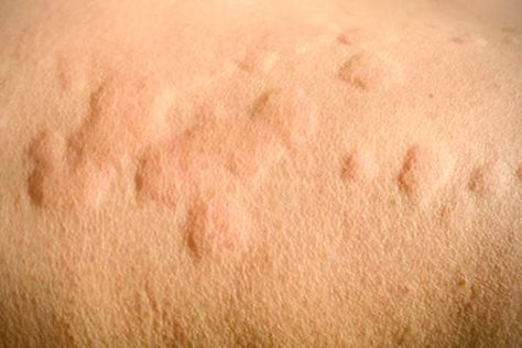 3 Women Living With Chronic Hives | HealthCentral Hives Causes, Chronic Hives, Yeast Infection Causes, Pineapple Health Benefits, Skin Allergies, Summer Skin, Natural Remedy, Itchy Skin, Yeast