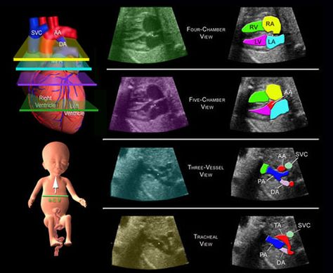 Fetal Echocardiography Ultrasound Humor, Diagnostic Medical Sonography Student, Ultrasound School, Obstetric Ultrasound, Cardiac Sonography, Sonography Student, Vascular Ultrasound, Ultrasound Sonography, Radiology Student