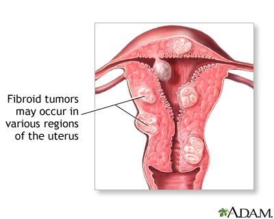 Uterine fibroids Uterine fibroids are tumors that grow in a woman's womb (uterus). These growths are typically not cancerous (benign). Fibroid Uterus, Fibroid Tumors, Women Health, Personal Health, Health Matters, Health Info, Natural Treatments, Natural Medicine, Health Remedies