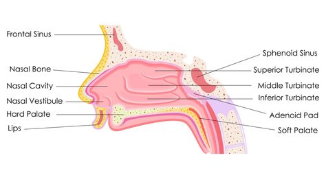 Sinus passages.  Sinusitis and upper airway symptoms in bronchiectasis.  Rhinosinusitis is inflammation of the nasal passages and paranasal sinuses, which leads to a build-up of mucus production which may increase the risk of infection (Fig.1).  Upper airway symptoms in the form of rhinosinusitis may present in some people with bronchiectasis. Paranasal Sinuses, Nasal Obstruction, Chronic Sinusitis, The Respiratory System, Upper Respiratory Infection, Chronic Obstructive Pulmonary Disease, Nasal Passages, Pulmonary Disease, Nasal Spray