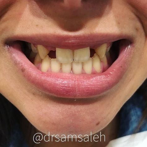 This lovely young lady traveled to see me for non surgical replacement of missing teeth. I’m thrilled that she is finally able to smile… Missing Teeth Smile, Messed Up Teeth, Eyebrow Slits, Cheek Piercings, Royal Au, Bridge Piercing, Missing Tooth, Oc Reference, Inspirational Board