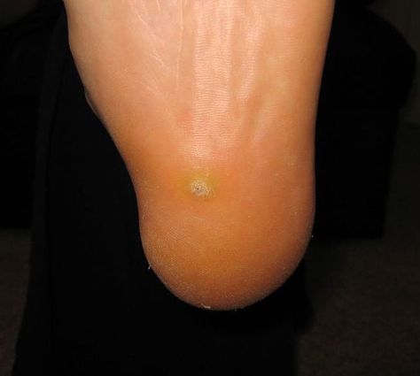 See What Plantar Warts Look Like on Your Feet: How Plantar Warts Appear on Your Foot Planters Warts On Foot, Seed Wart, Plantar Wart Removal, Filiform Wart, Planters Wart, Plantar Warts, Warts On Hands, Warts On Face, Home Remedies For Warts