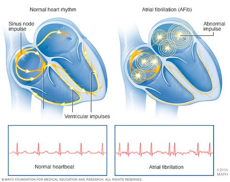 Atrial fibrillation Atrial Fibrillation Symptoms, Normal Heart, Congenital Heart, Atrial Fibrillation, Heart Rhythms, Coronary Arteries, Cardiovascular System, Mayo Clinic, Cardiology