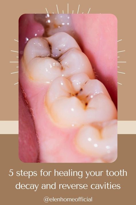 Tooth decay, also known as dental caries or cavities, is kind of like that uninvited guest at a party—it shows up when you least expect it and can be a real downer. But what if I told you that you could potentially send this party crasher packing before it gets too comfortable? That’s right, the reversal of tooth decay is a thing, and we’re going to explore the ins and outs of it. ... less How To Reverse Cavities Naturally, Tooth Decay Remedies Heal Cavities, How To Get Rid Of Cavities At Home, How To Remove Cavity From Teeth, How To Reverse Cavities, Reverse Tooth Decay Heal Cavities, How To Get Rid Of Cavities, Reversing Cavities, Cavity Remedy Diy