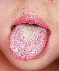 Ayurvedic Tongue Analysis: What does your tongue say about your health? - Svastha Ayurveda Yeast Infection Medication, Yeast Infection Men, Chronic Yeast Infection, Candida Symptoms, Treat Yeast Infection, Candida Yeast Infection, Yeast Infection Causes, Yeast Infection Symptoms, Candida Yeast