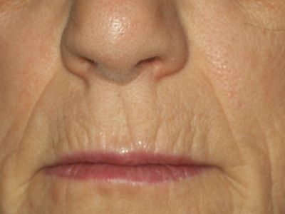 59 Year Old Full Face Dual Erbium Laser in OR.,Eye Lift Surgery,Fat Transfer to Cheeks,Lower Lid Lift recommends Dr. Wulc, WComestic, King of Prussia, PA Eye Lift Surgery, Erbium Laser, Surgery Doctor, Laser Resurfacing, Fat Transfer, King Of Prussia, Eye Lift, Cosmetic Surgery, Full Face