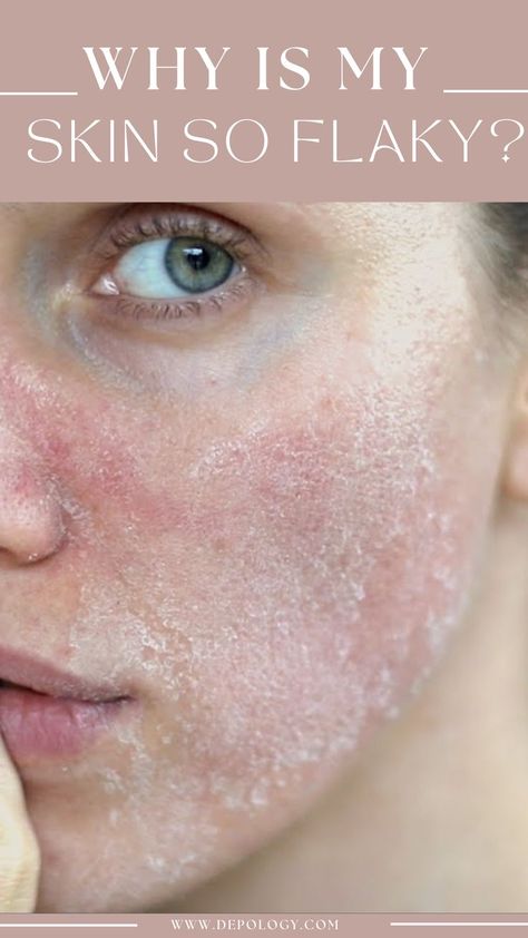 There is often a specific reason for those who see these symptoms. Getting down to the root of the issue is the first step to ensuring you are able to either treat or maintain your skin concerns, no longer thinking about them on a daily. Extremely Dry Face, Flaky Skin On Face, Dry Patchy Skin, Dry Skin Home Remedies, Patchy Skin, Super Dry Skin, Self Consciousness, Severe Dry Skin, Type Of Skin