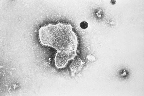 Respiratory syncytial virus (RSV) infection is usually mild. But infants, seniors and the chronically ill can have severe respiratory syncytial virus symptoms. Dog Coughing, Guillain Barre, Guillain Barre Syndrome, Respiratory Illness, Medicine Journal, Respiratory Diseases, Emergency Department, Baby Protection, Childrens Hospital