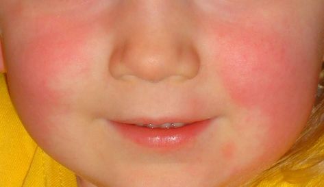 Common Baby Rashes, baby rash on face, baby rash remedies, baby rash on neck, diaper rash remedies. Fever Rash, Strep Throat, Ehlers Danlos Syndrome, Serious Illness, Skin Allergies, Abdominal Pain, Signs And Symptoms, Natural Treatments, Warning Signs